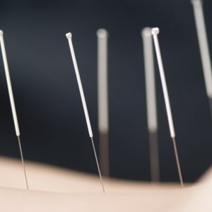 Treatment by acupuncture Needles for treatment of the patient